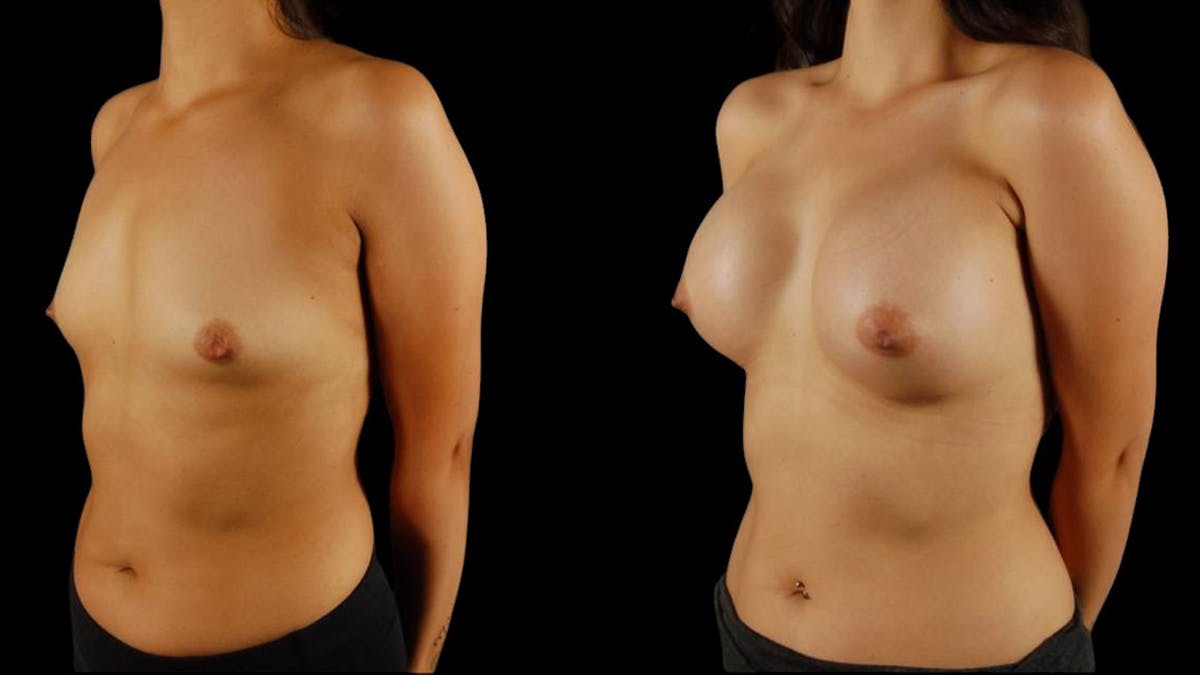Breast Augmentation Before & After Gallery - Patient 269484 - Image 4