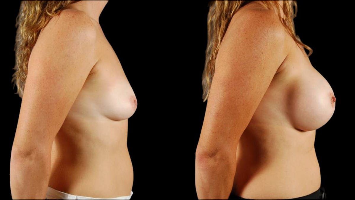 Breast Augmentation Before & After Gallery - Patient 269484 - Image 5