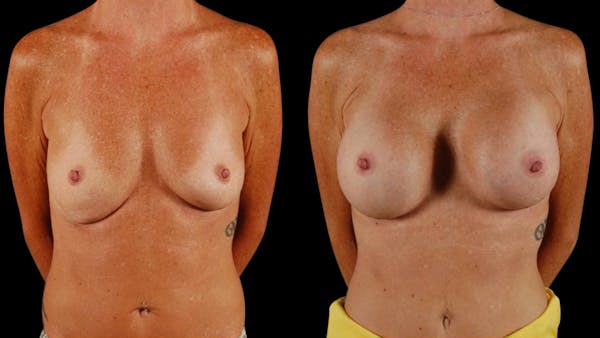 Breast Augmentation Before & After Gallery - Patient 459131 - Image 1