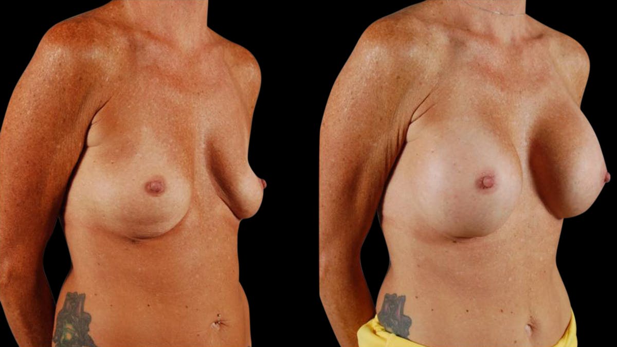 Breast Augmentation Before & After Gallery - Patient 459131 - Image 2