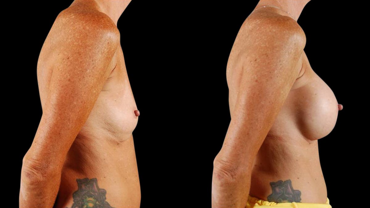 Breast Augmentation Before & After Gallery - Patient 459131 - Image 3