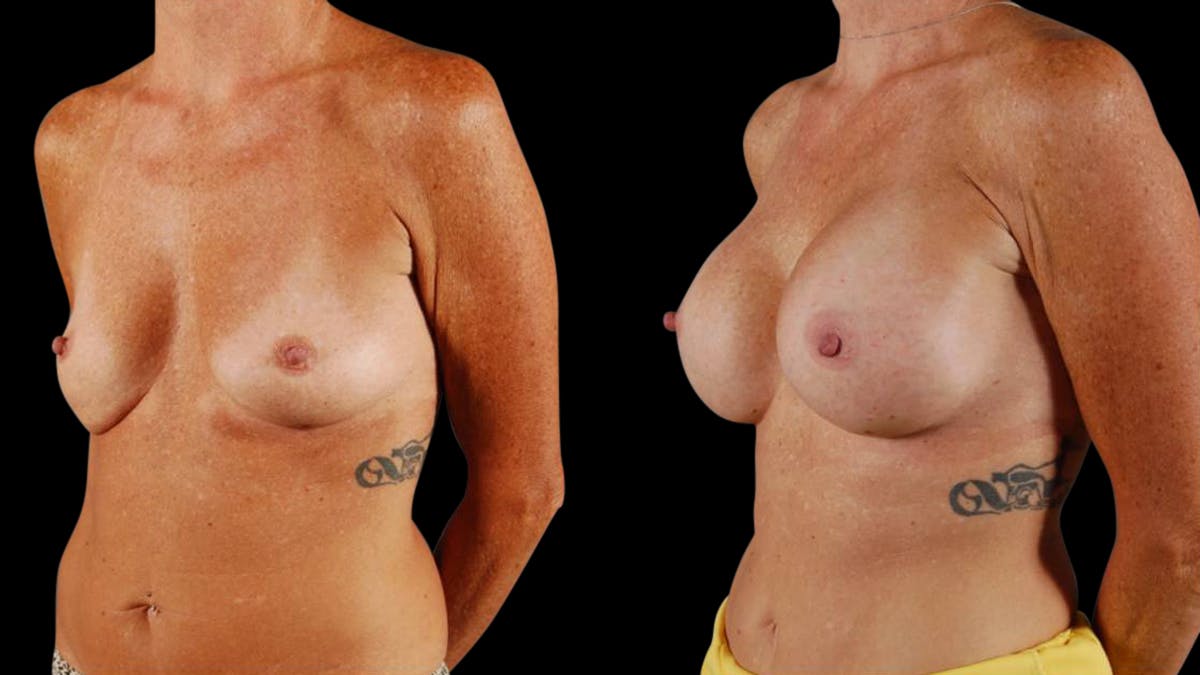 Breast Augmentation Before & After Gallery - Patient 459131 - Image 4