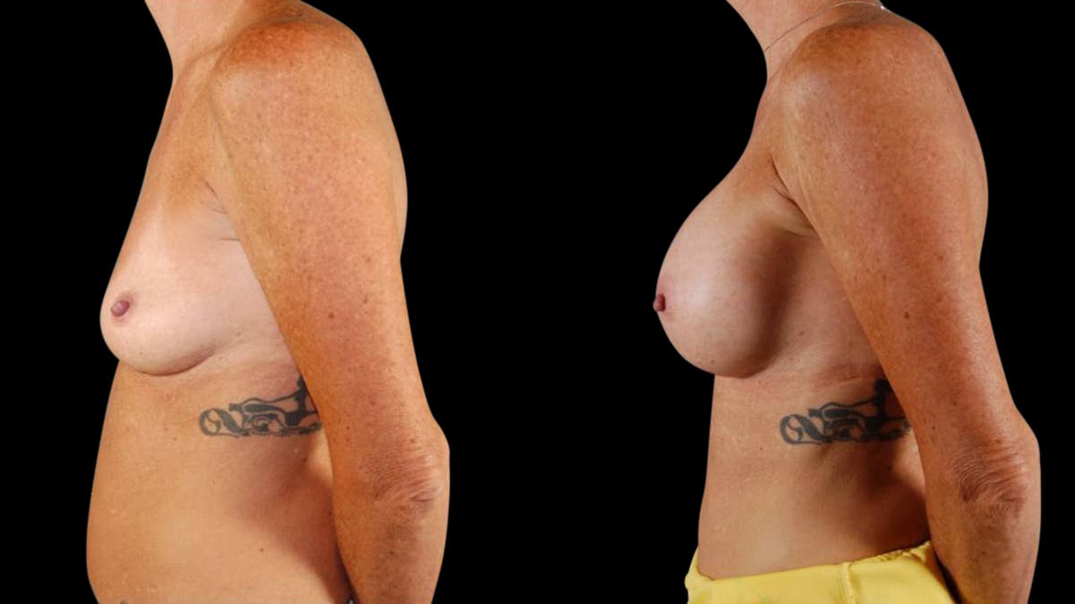 Breast Augmentation Before & After Gallery - Patient 459131 - Image 5
