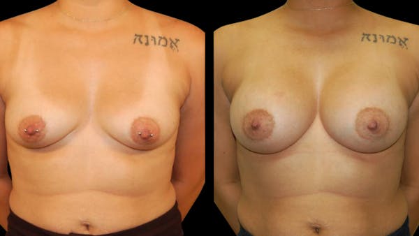 Breast Augmentation Before & After Gallery - Patient 212502 - Image 1