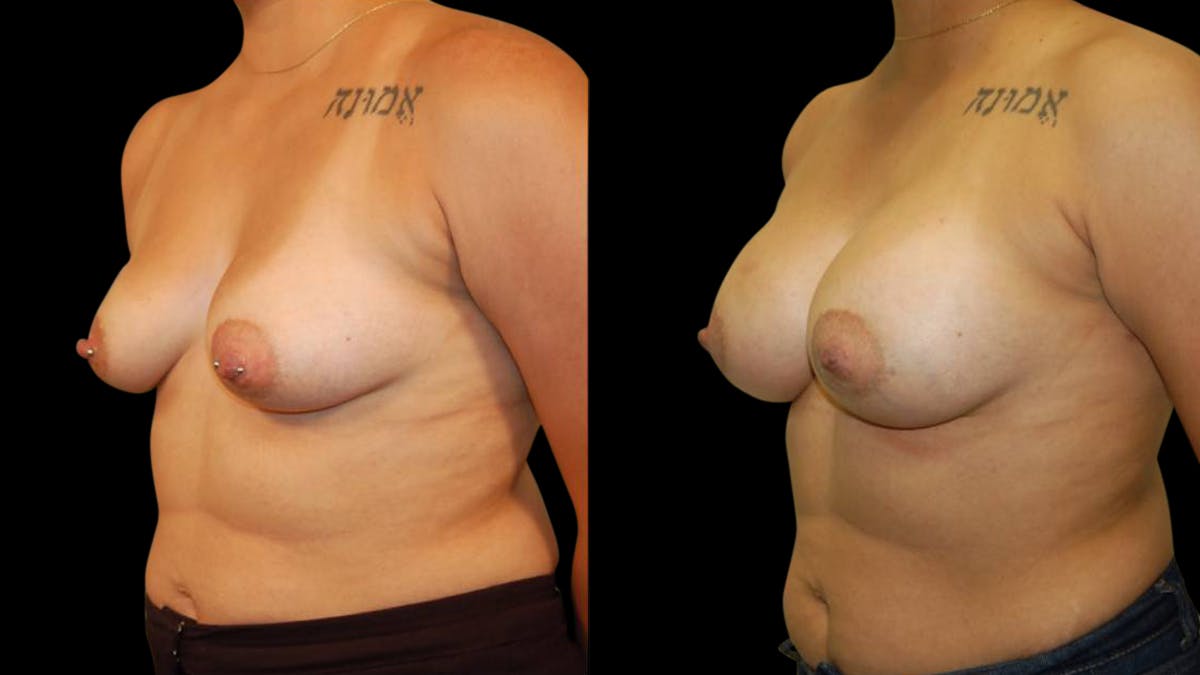 Breast Augmentation Before & After Gallery - Patient 212502 - Image 2