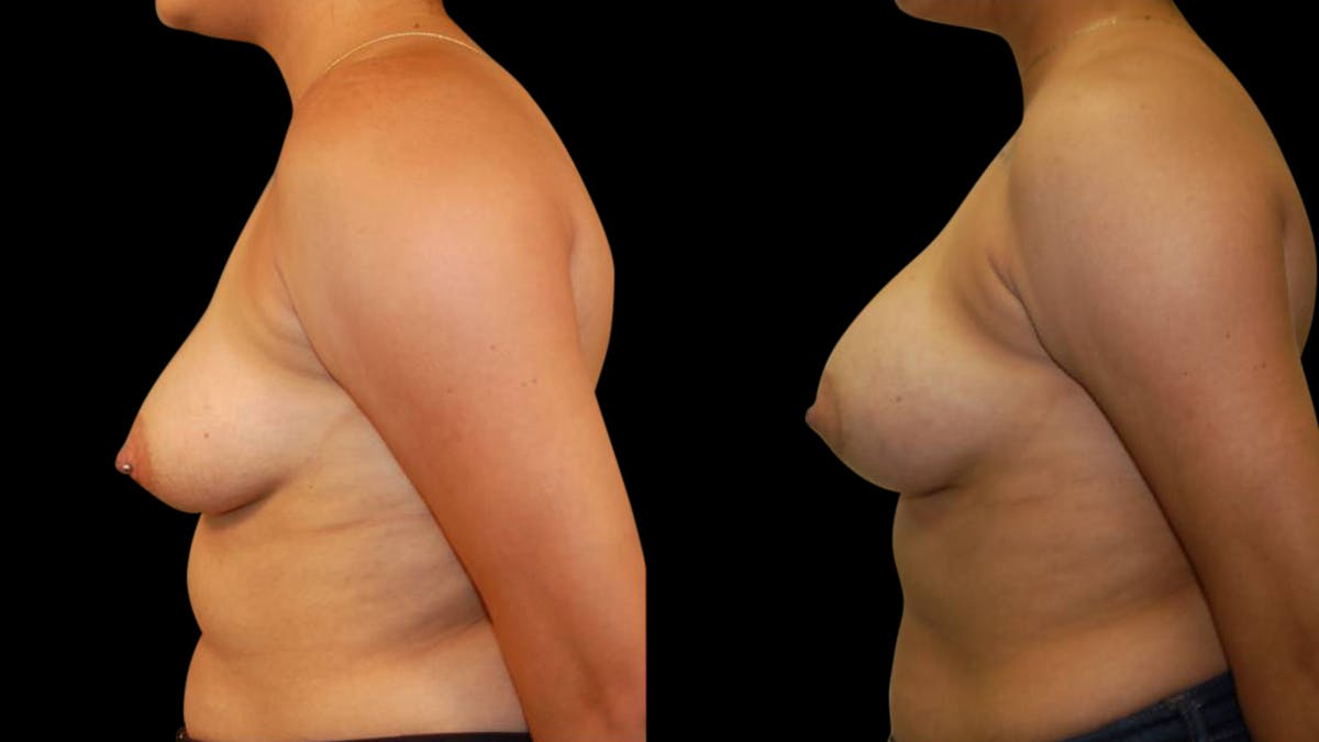 Breast Augmentation Before & After Gallery - Patient 212502 - Image 3