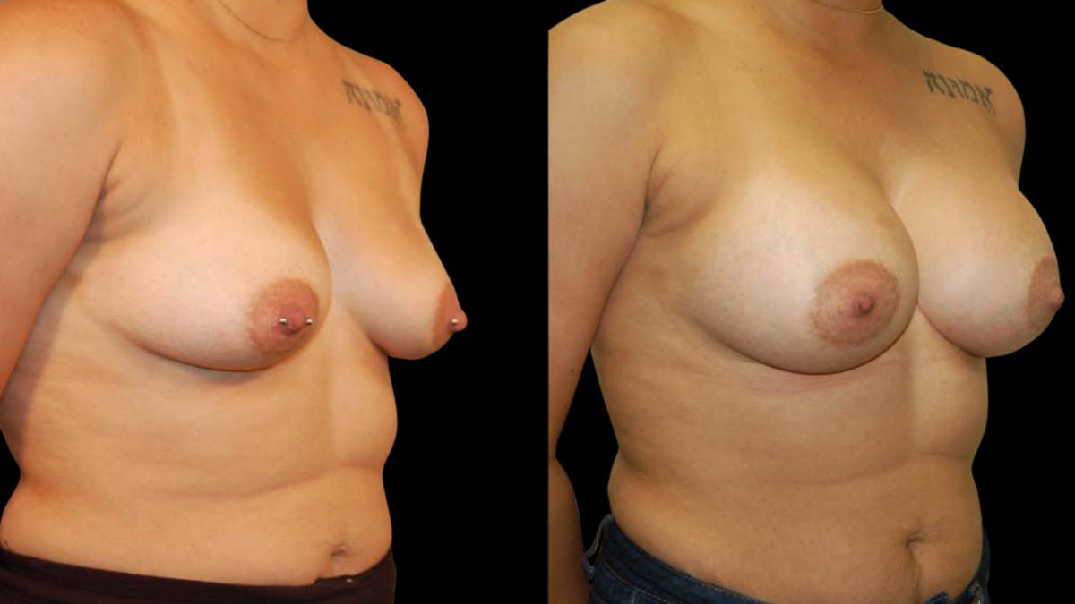 Breast Augmentation Before & After Gallery - Patient 212502 - Image 4