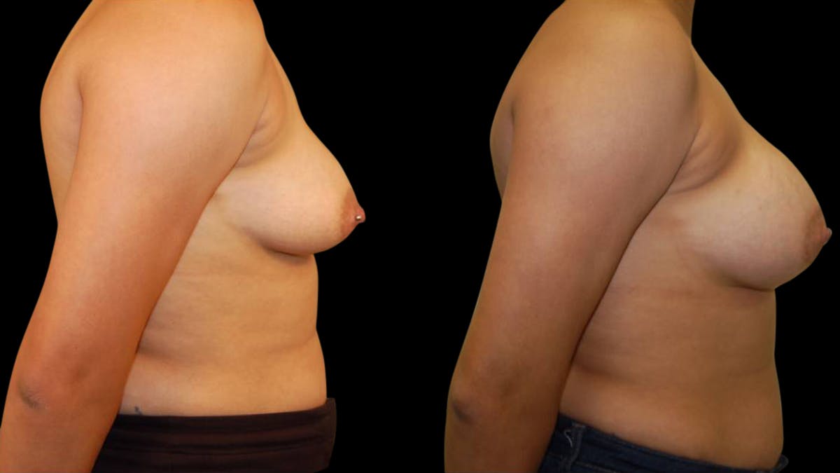 Breast Augmentation Before & After Gallery - Patient 212502 - Image 5
