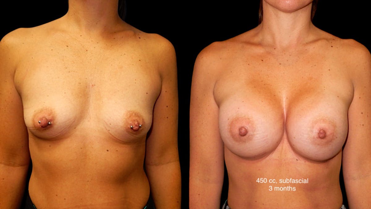 Breast Augmentation Before & After Gallery - Patient 285253 - Image 1