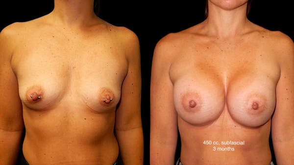 Breast Augmentation Before & After Gallery - Patient 285253 - Image 1