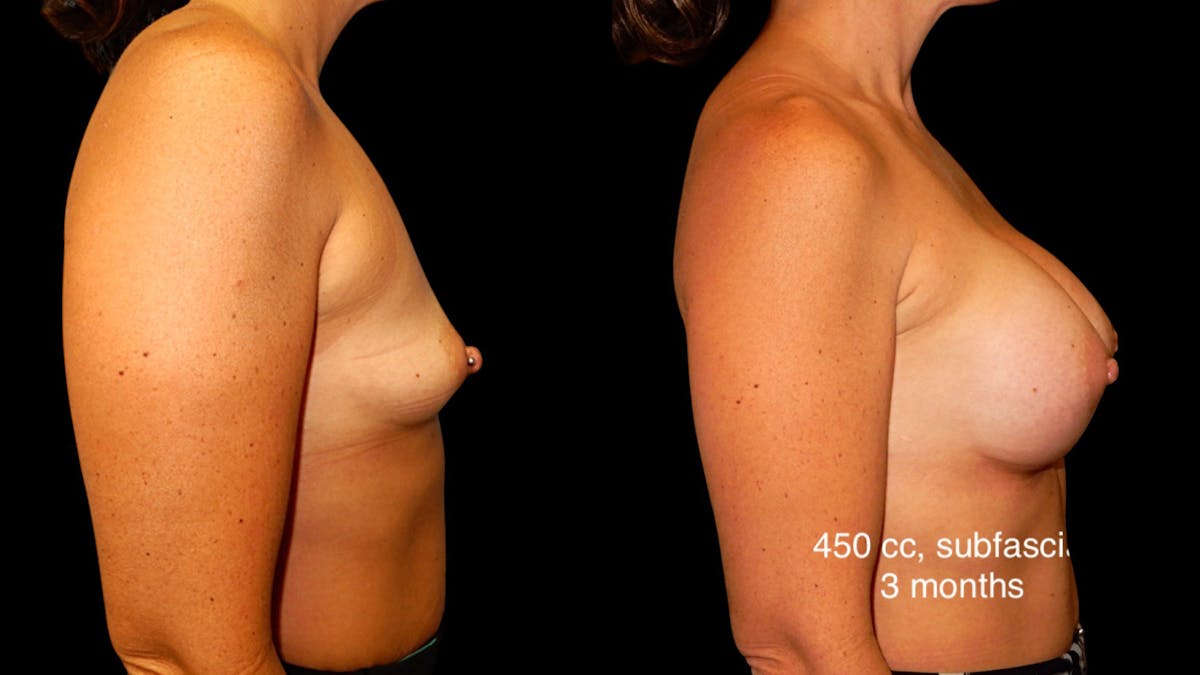 Breast Augmentation Before & After Gallery - Patient 285253 - Image 3