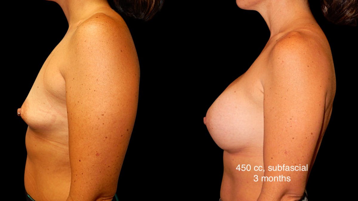 Breast Augmentation Before & After Gallery - Patient 285253 - Image 5