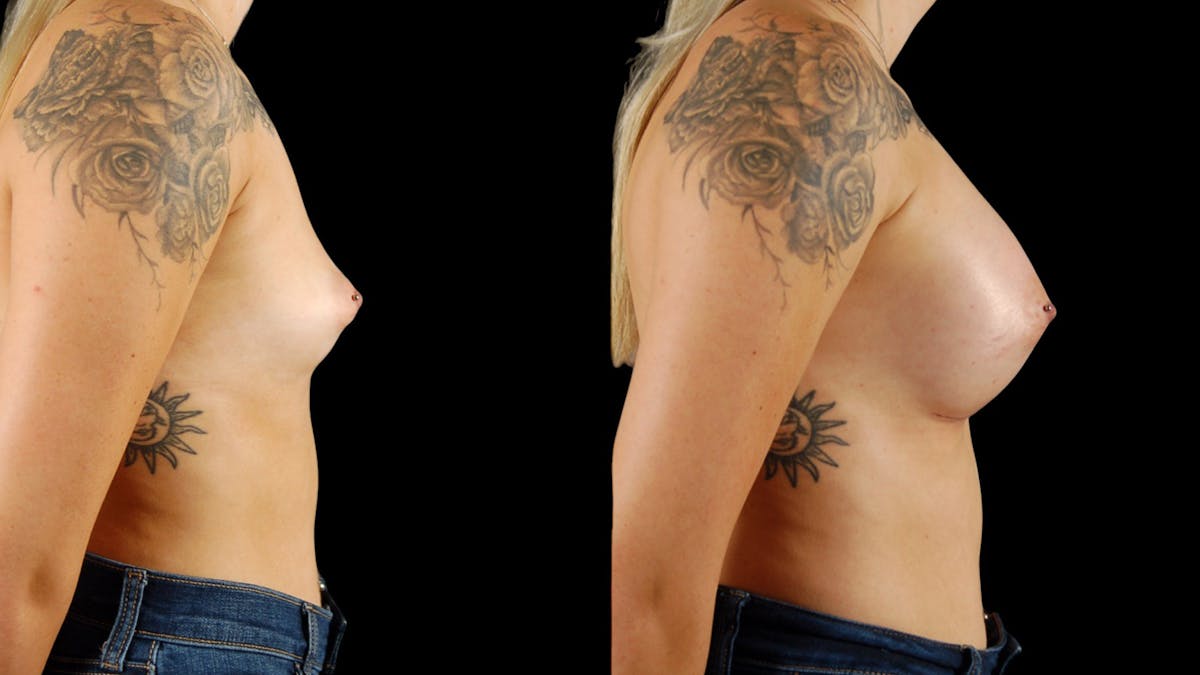 Breast Augmentation Before & After Gallery - Patient 488398 - Image 4