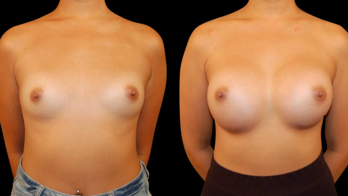 Breast Augmentation Before & After Gallery - Patient 269260 - Image 1