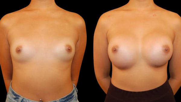 Breast Augmentation Before & After Gallery - Patient 269260 - Image 1