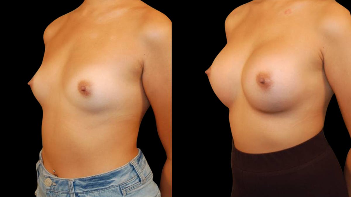 Breast Augmentation Before & After Gallery - Patient 269260 - Image 2