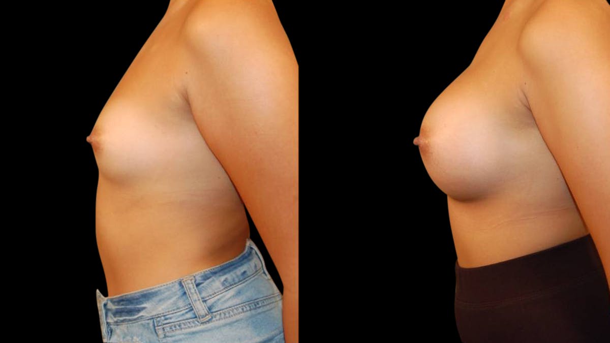 Breast Augmentation Before & After Gallery - Patient 269260 - Image 3