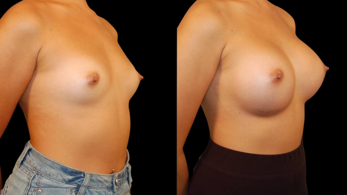 Breast Augmentation Before & After Gallery - Patient 269260 - Image 4