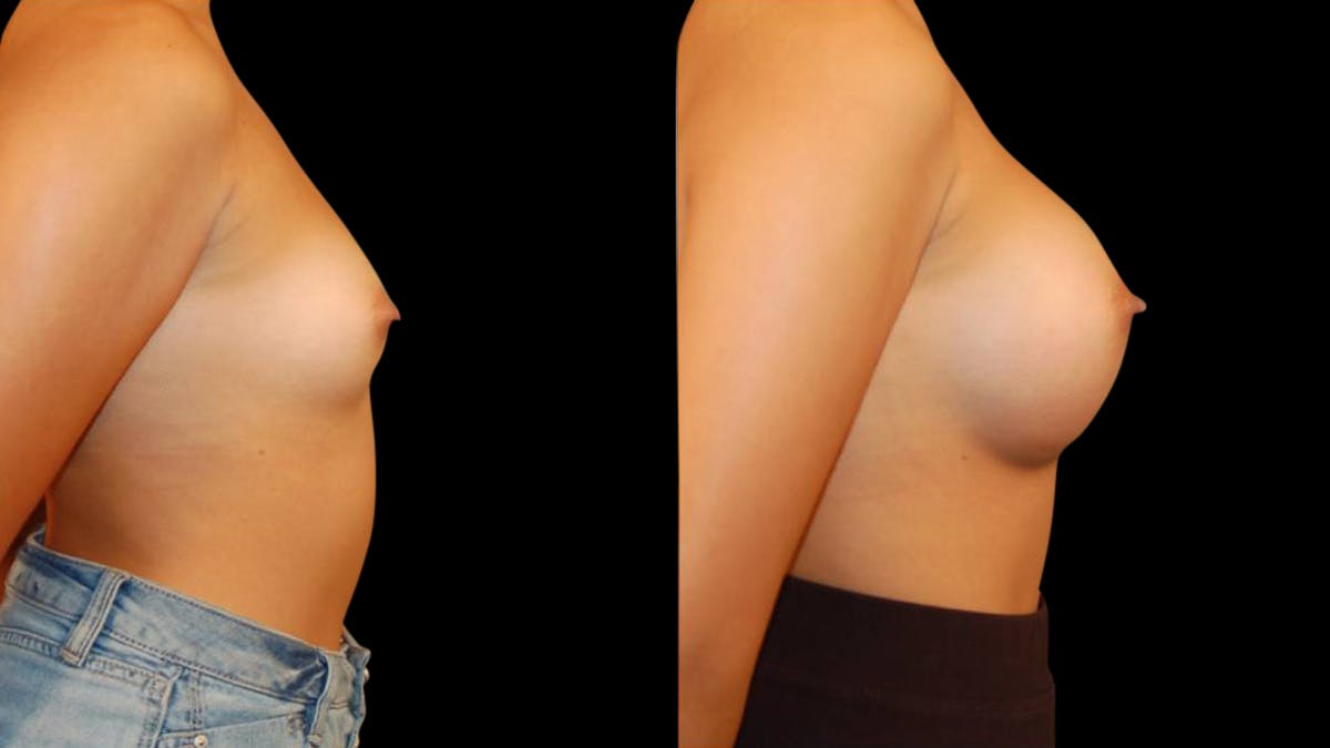 Breast Augmentation Before & After Gallery - Patient 269260 - Image 5