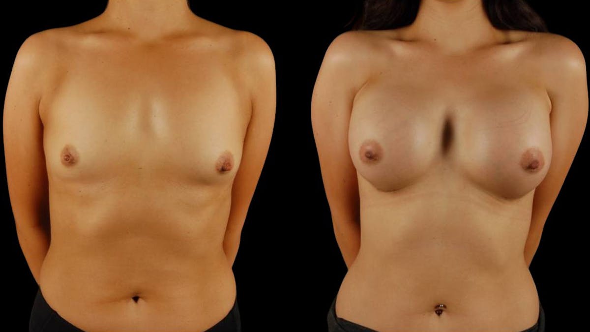 Breast Augmentation Before & After Gallery - Patient 415325 - Image 1