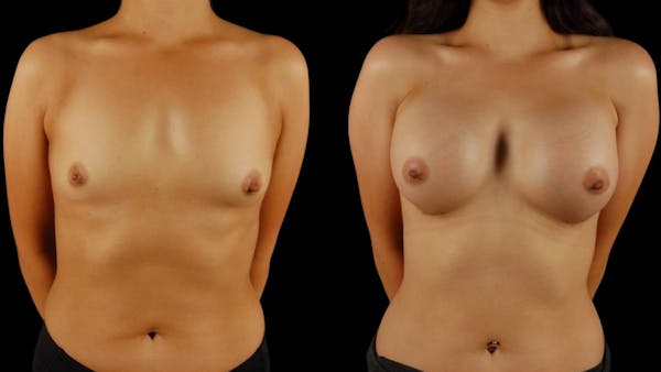 Breast Augmentation Before & After Gallery - Patient 415325 - Image 1