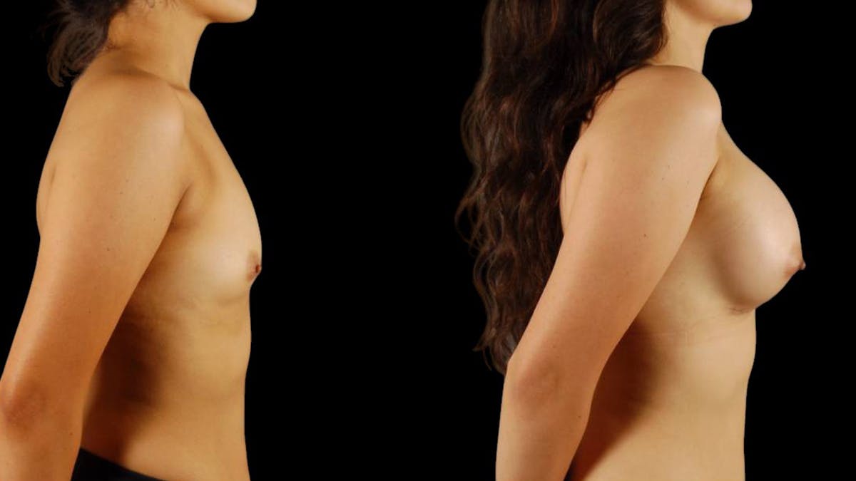 Breast Augmentation Before & After Gallery - Patient 415325 - Image 3
