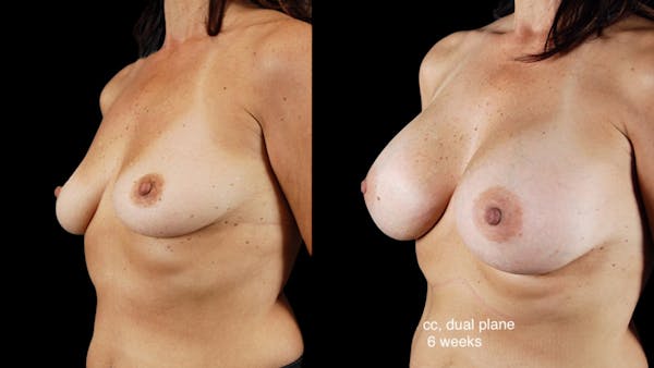Breast Augmentation Before & After Gallery - Patient 181776 - Image 1