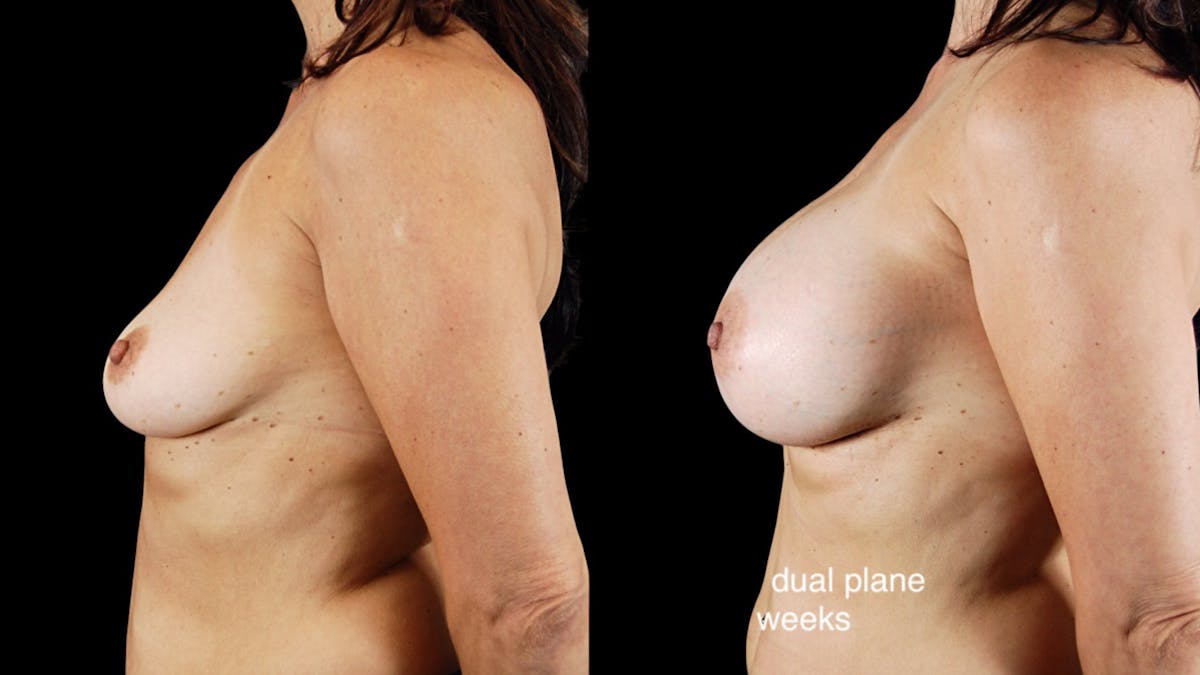 Breast Augmentation Before & After Gallery - Patient 181776 - Image 2