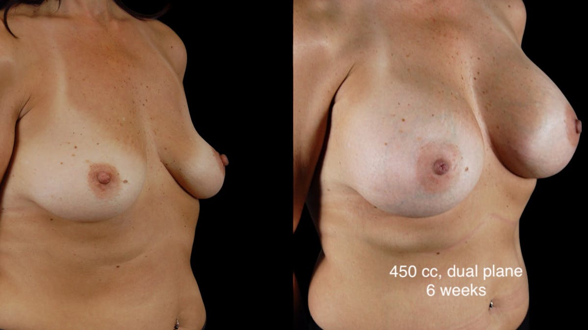 Breast Augmentation Before & After Gallery - Patient 181776 - Image 3