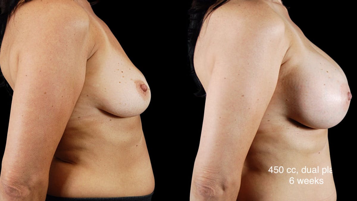 Breast Augmentation Before & After Gallery - Patient 181776 - Image 4