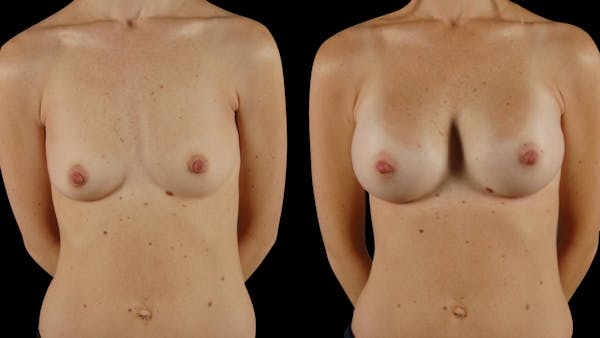 Breast Augmentation Before & After Gallery - Patient 100573 - Image 1