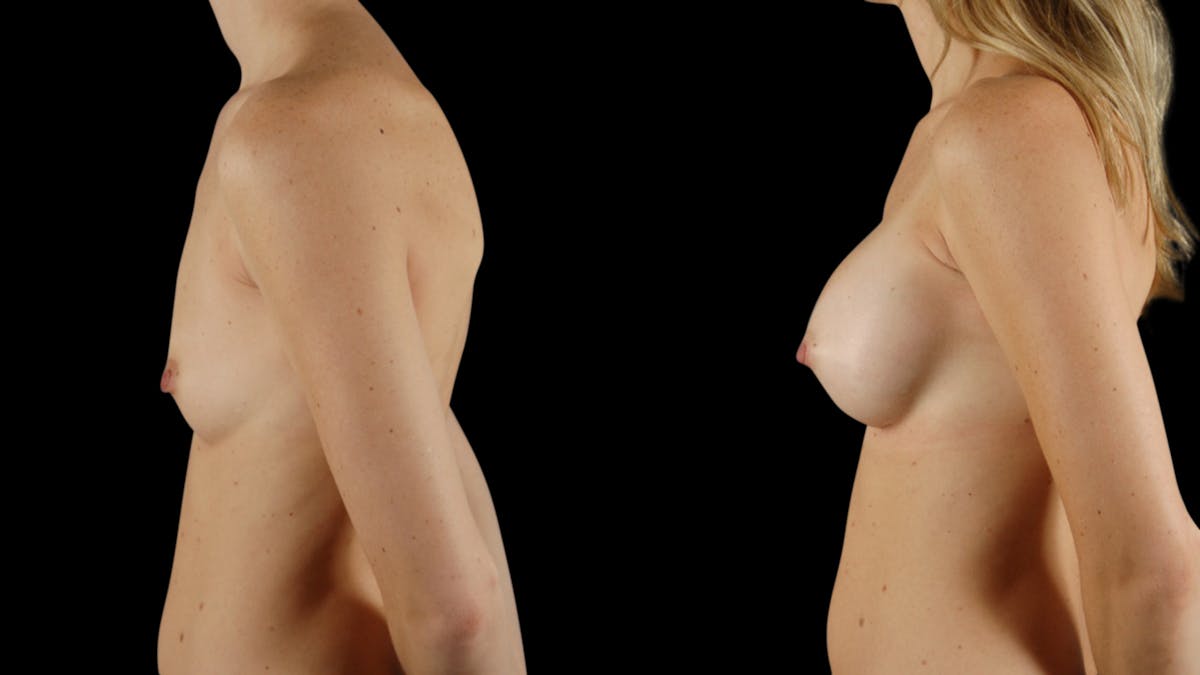 Breast Augmentation Before & After Gallery - Patient 100573 - Image 3