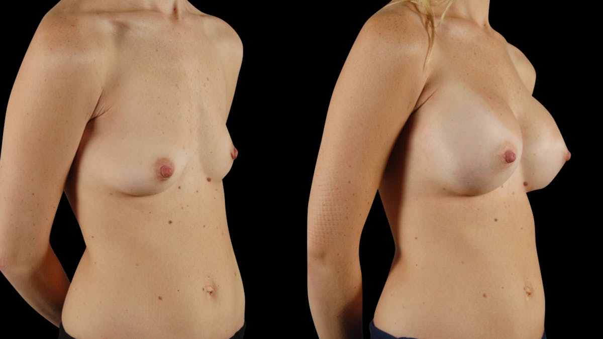 Breast Augmentation Before & After Gallery - Patient 100573 - Image 4
