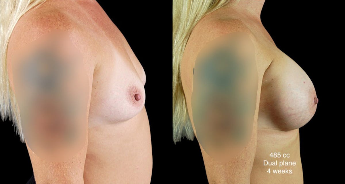 Breast Augmentation Before & After Gallery - Patient 254310 - Image 3