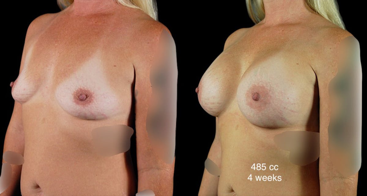 Breast Augmentation Before & After Gallery - Patient 254310 - Image 4