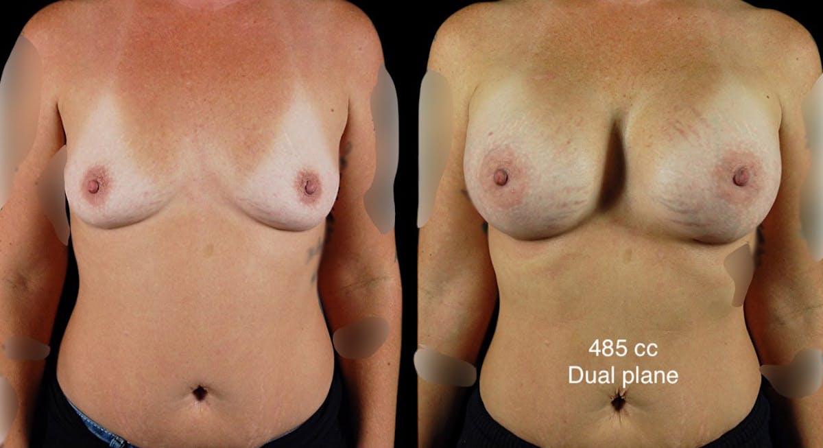 Breast Augmentation Before & After Gallery - Patient 254310 - Image 1