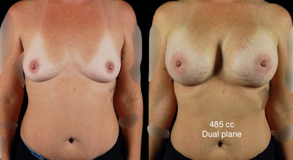 Breast Augmentation Before & After Gallery - Patient 254310 - Image 1