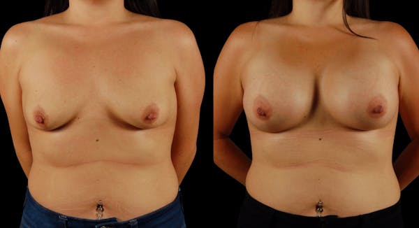 Breast Augmentation Before & After Gallery - Patient 199037 - Image 1