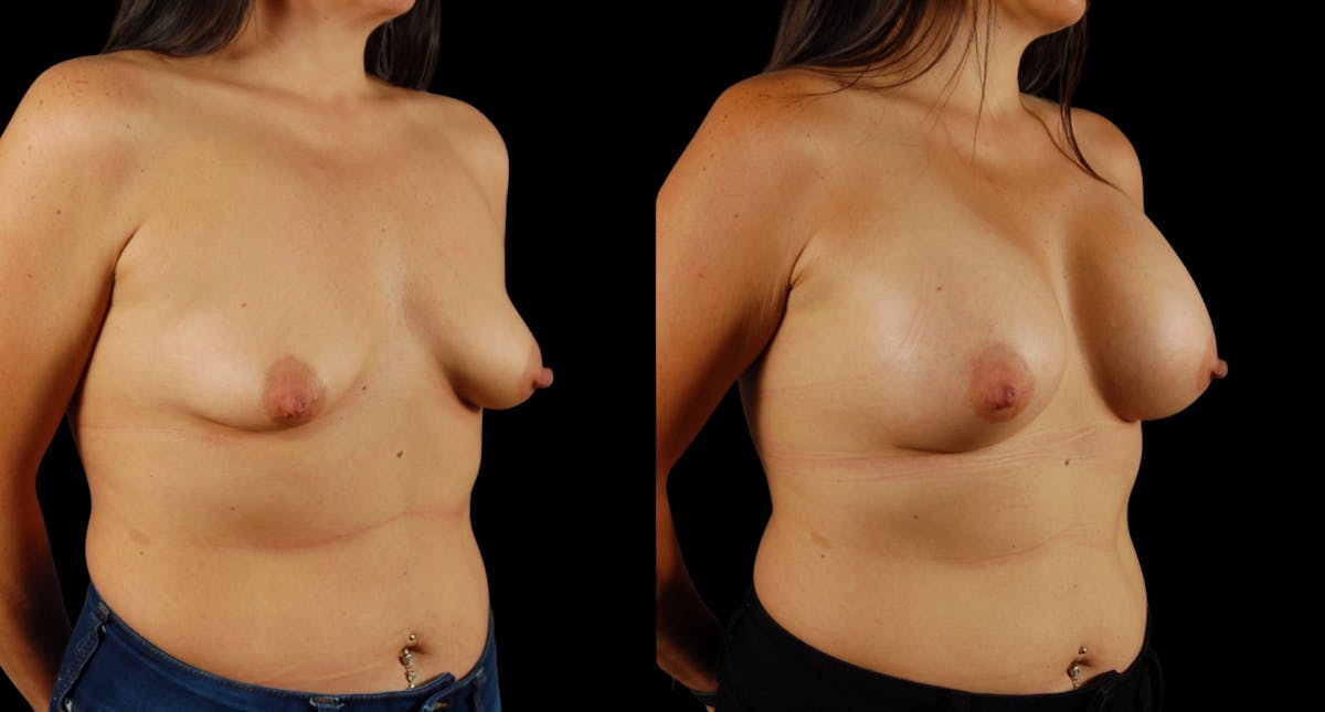Breast Augmentation Before & After Gallery - Patient 199037 - Image 2
