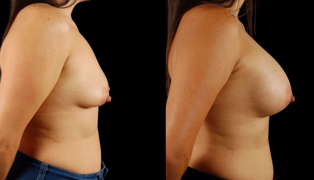 Breast Augmentation Before & After Gallery - Patient 199037 - Image 3
