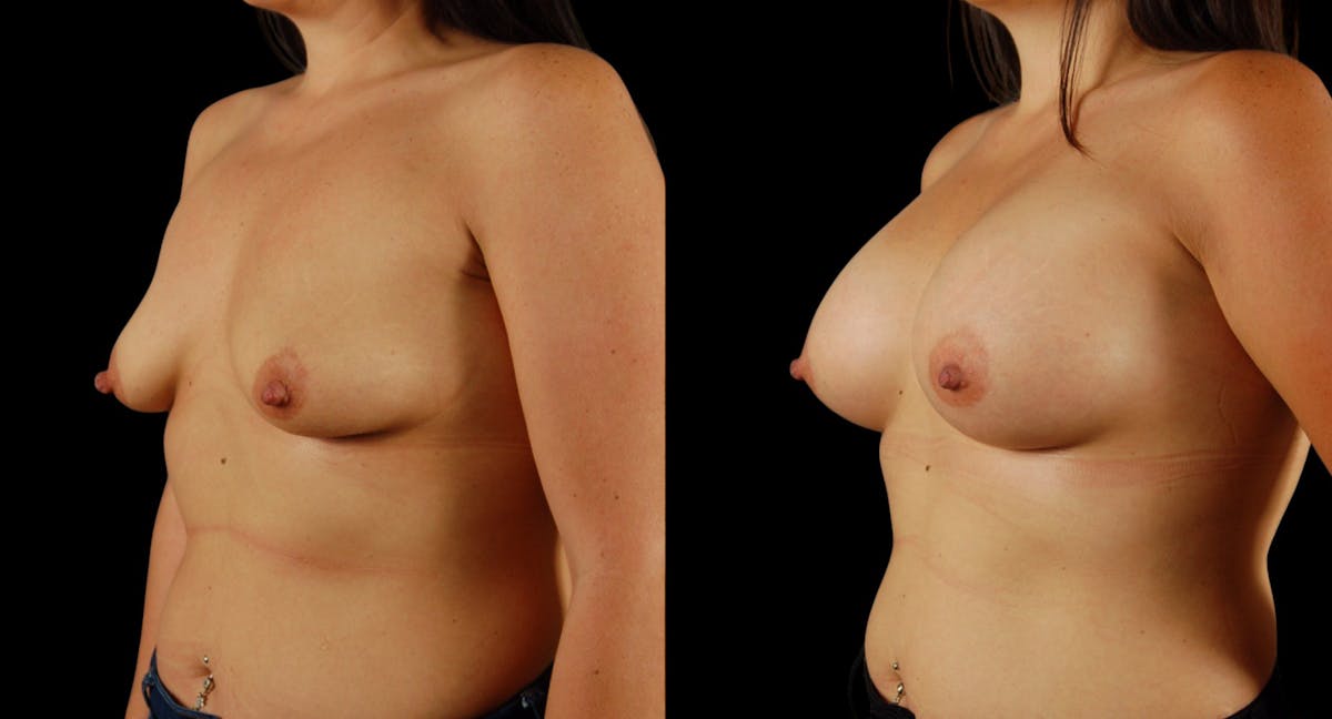 Breast Augmentation Before & After Gallery - Patient 199037 - Image 4