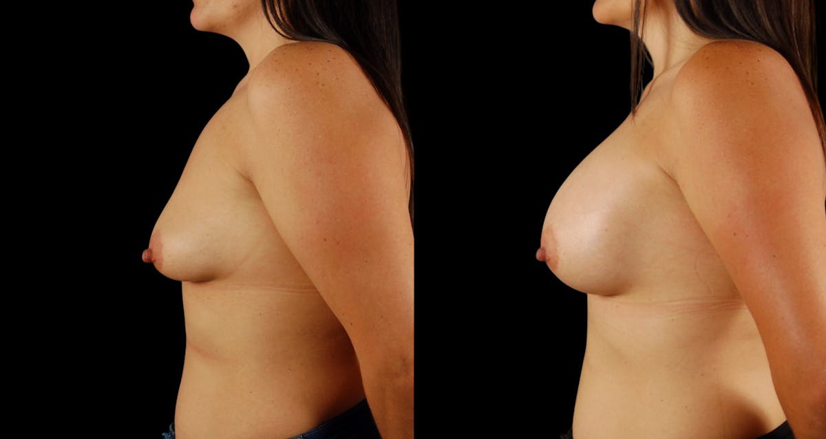 Breast Augmentation Before & After Gallery - Patient 199037 - Image 5