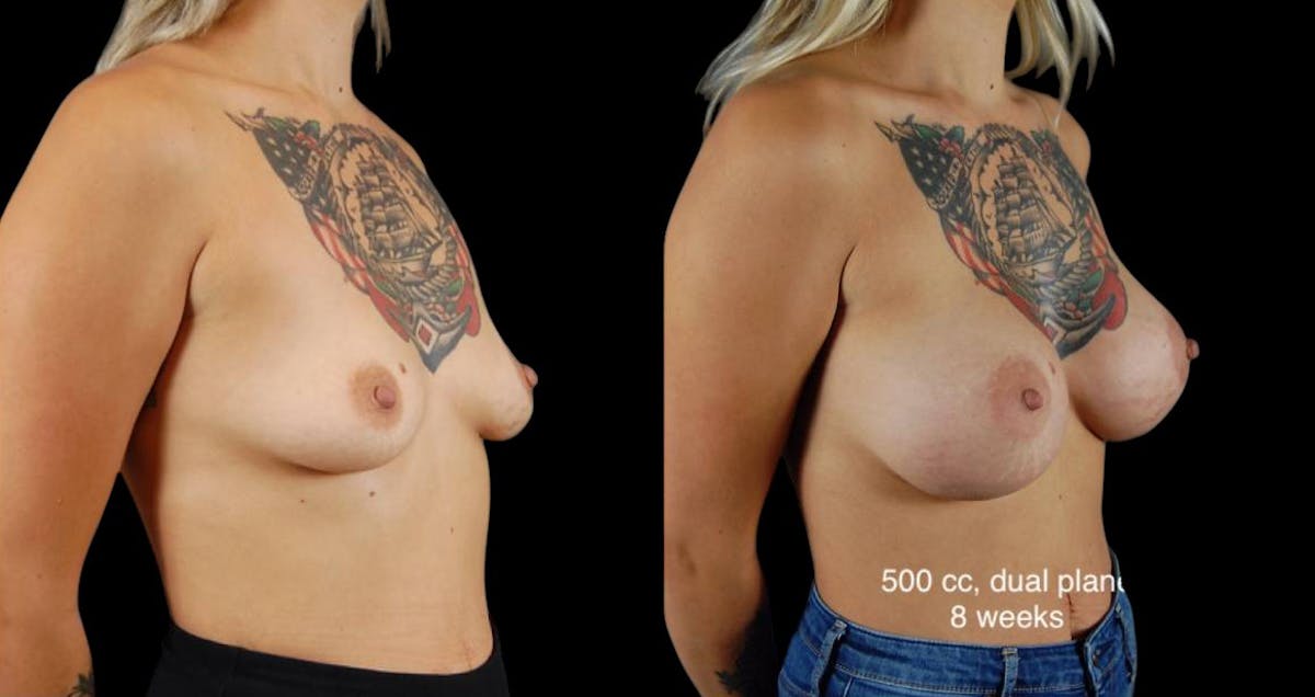 Breast Augmentation Before & After Gallery - Patient 176080 - Image 2