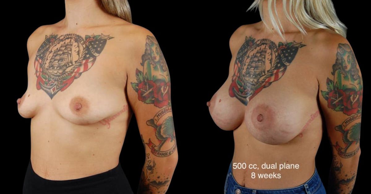 Breast Augmentation Before & After Gallery - Patient 176080 - Image 3