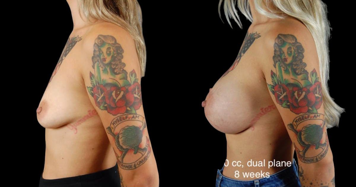 Breast Augmentation Before & After Gallery - Patient 176080 - Image 4