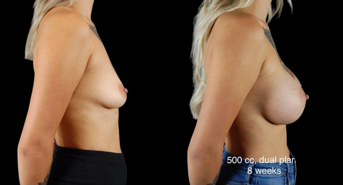 Breast Augmentation Before & After Gallery - Patient 176080 - Image 5