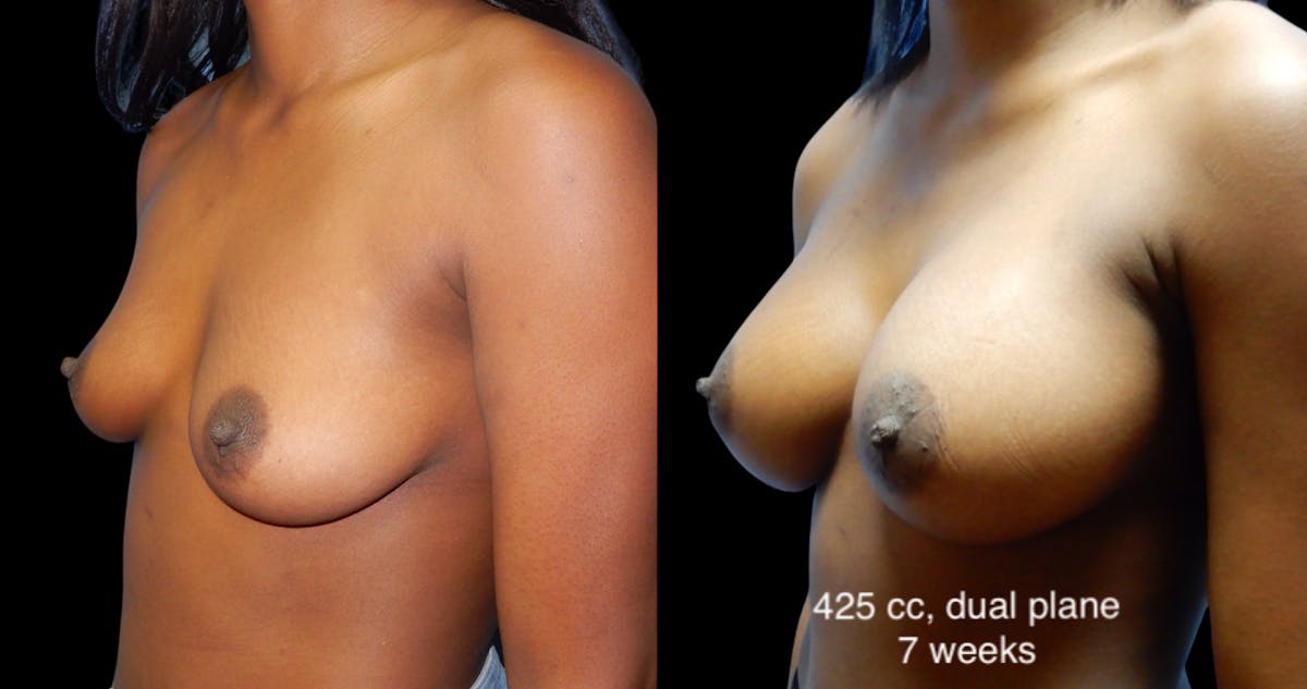 Breast Augmentation Before & After Gallery - Patient 205020 - Image 3