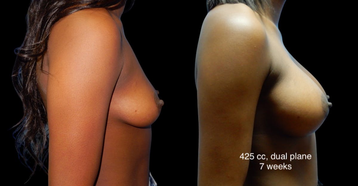 Breast Augmentation Before & After Gallery - Patient 205020 - Image 4