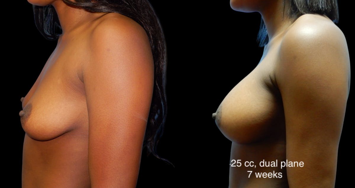 Breast Augmentation Before & After Gallery - Patient 205020 - Image 5