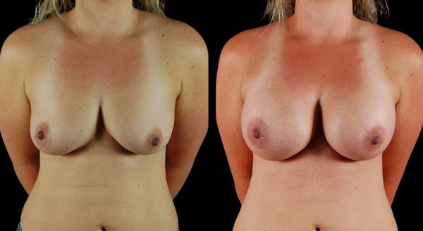 Breast Augmentation Before & After Gallery - Patient 166504 - Image 1